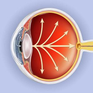 glaucoma-eye-3d_900